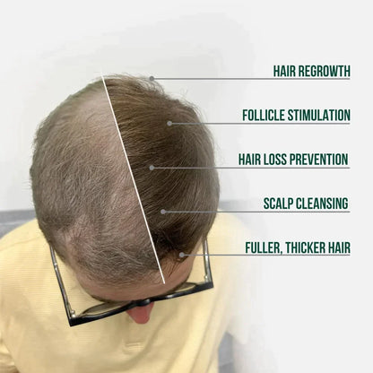 HAIR RESTORATION SYSTEM